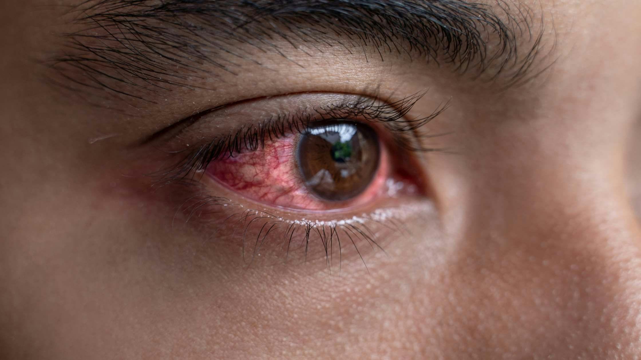 a close up of a man 's red eye with a tear coming out of it .