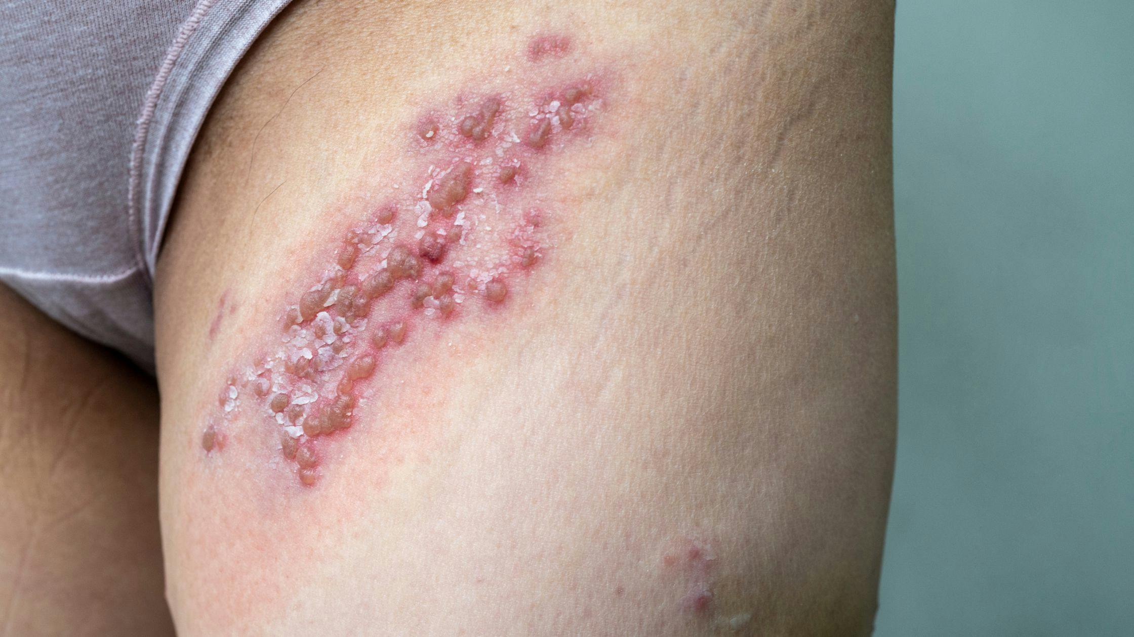 a close up of a person 's leg with a rash on it .
