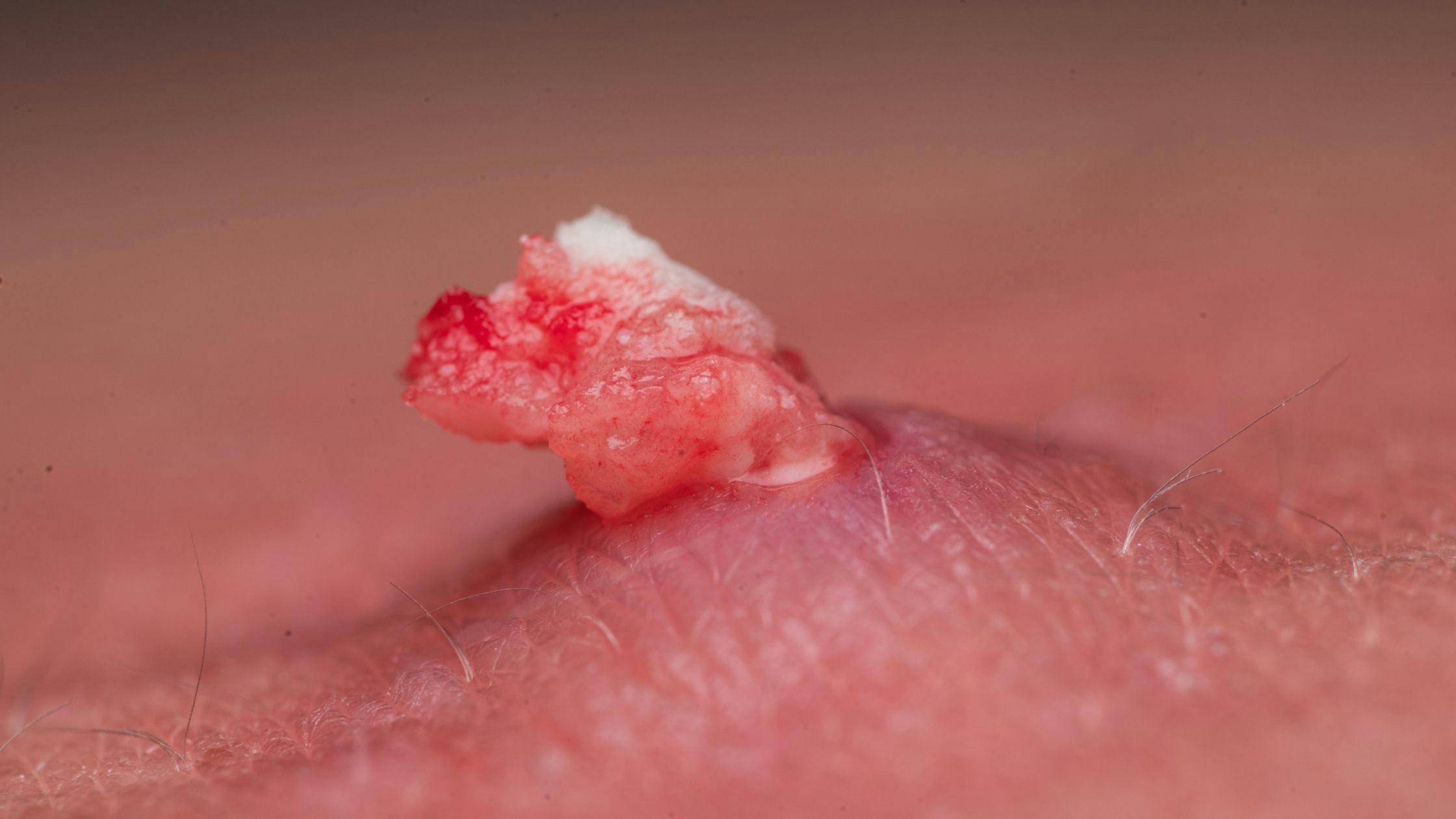 a close up of a wart on a person 's arm .