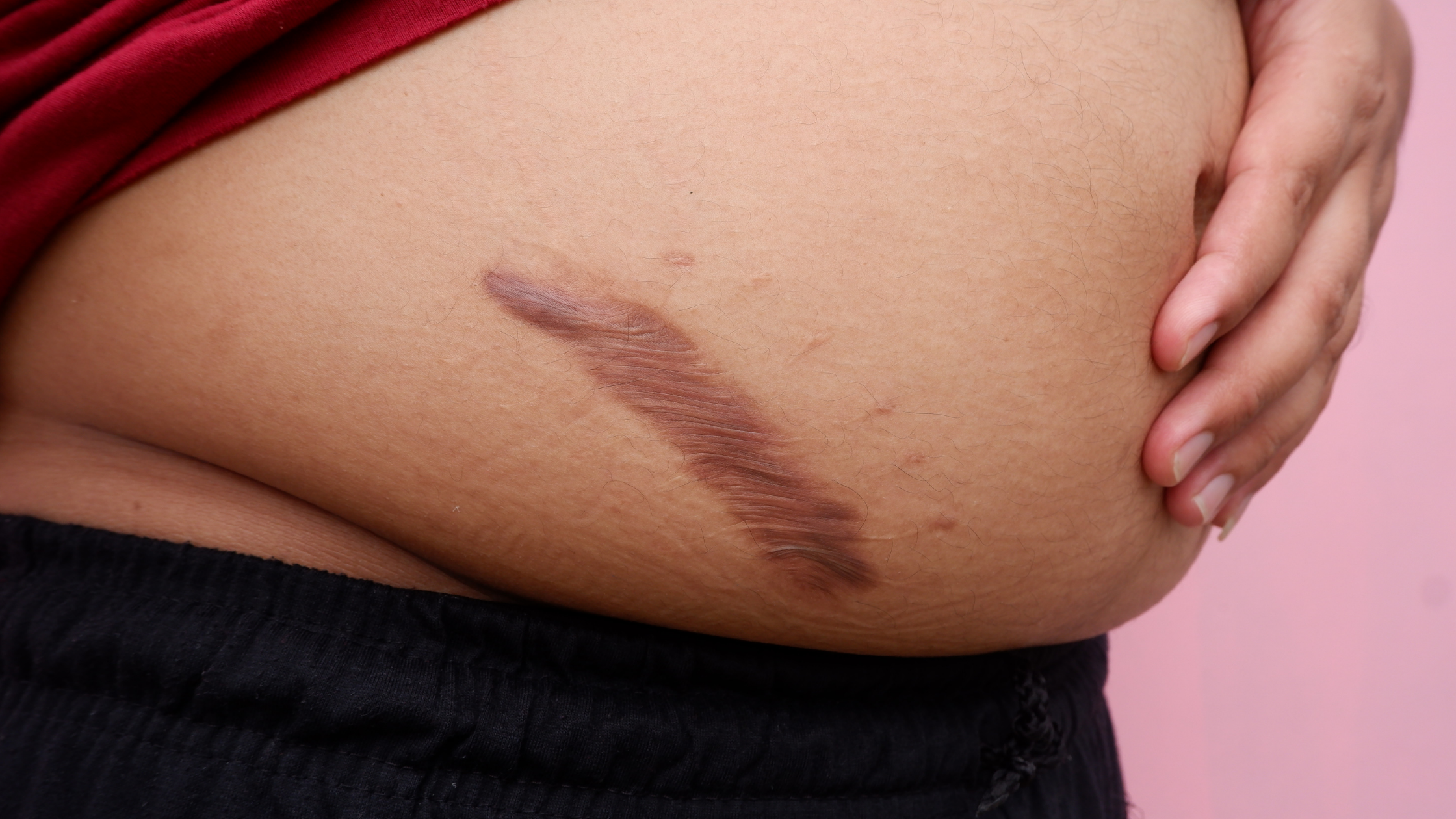 a woman 's stomach with a scar on it