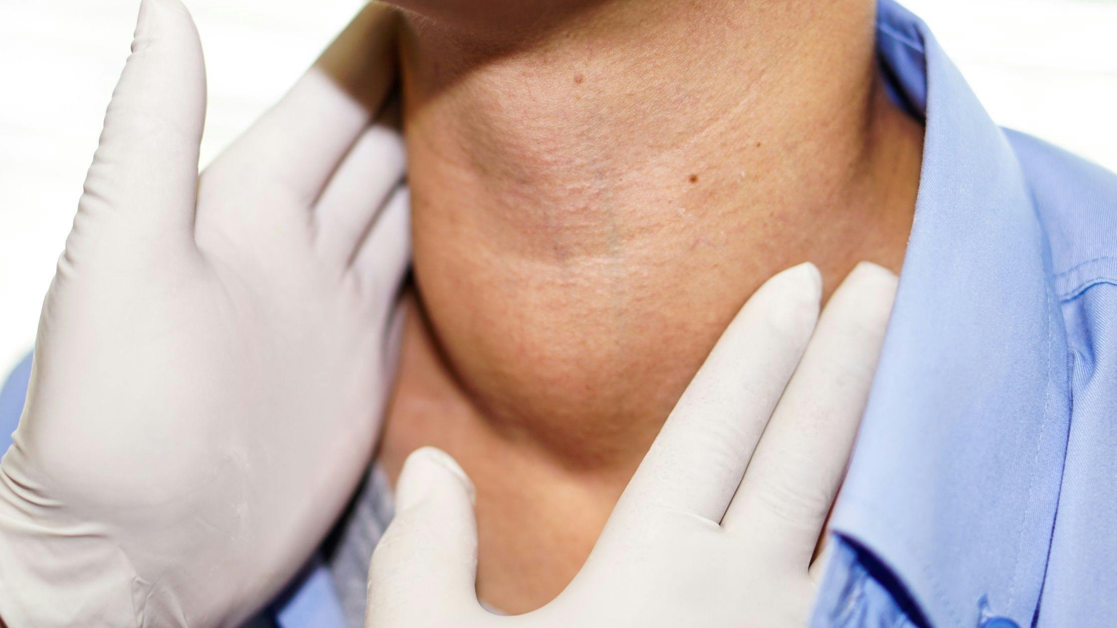 a doctor is examining a man 's thyroid gland .