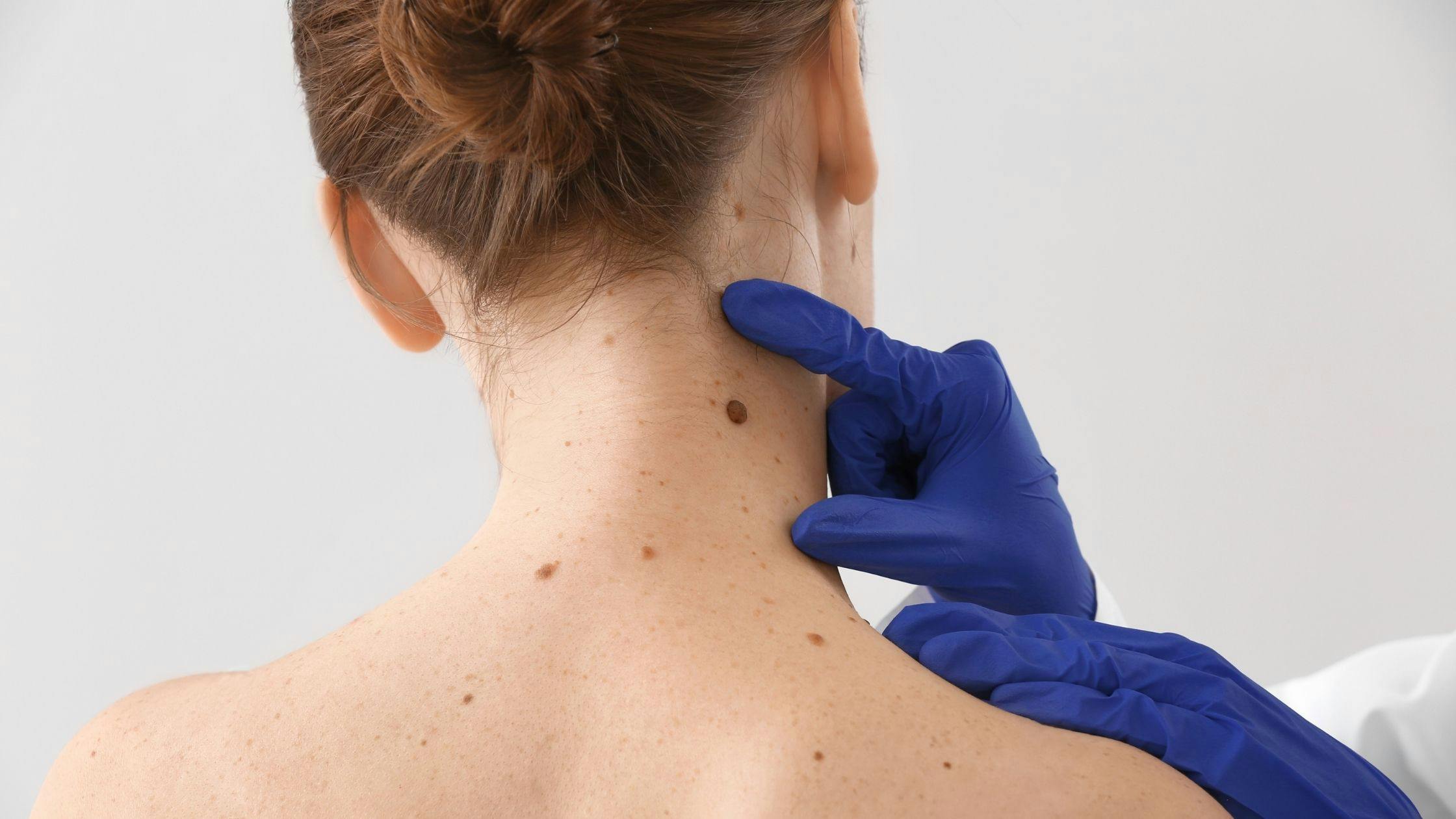 a doctor is examining a woman 's skin for moles .