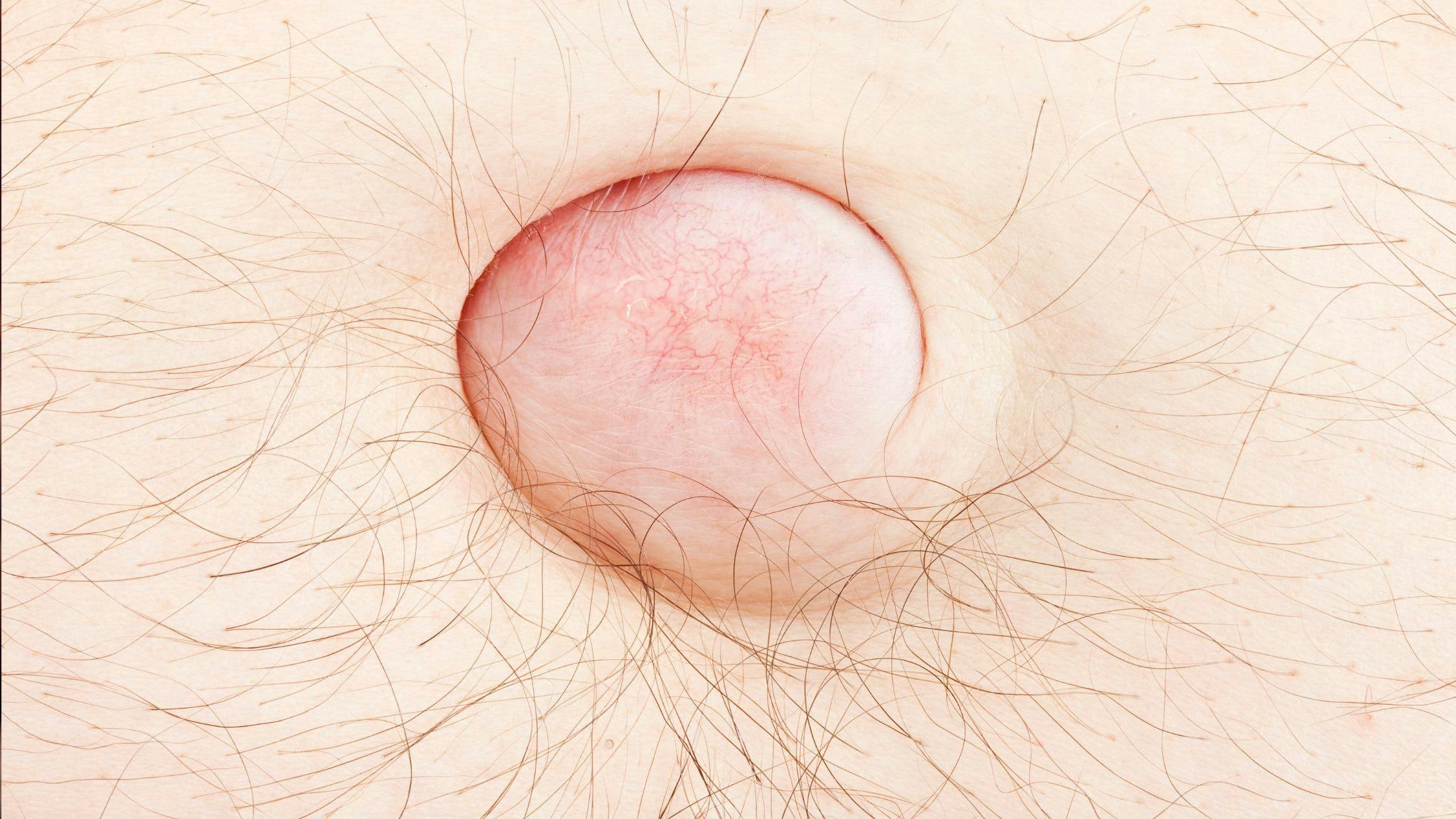 a close up of a person 's belly button with a red spot .