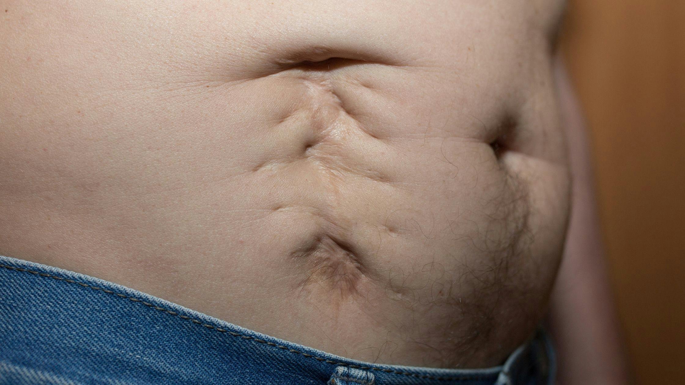 a close up of a person 's stomach with a few stitches on it .