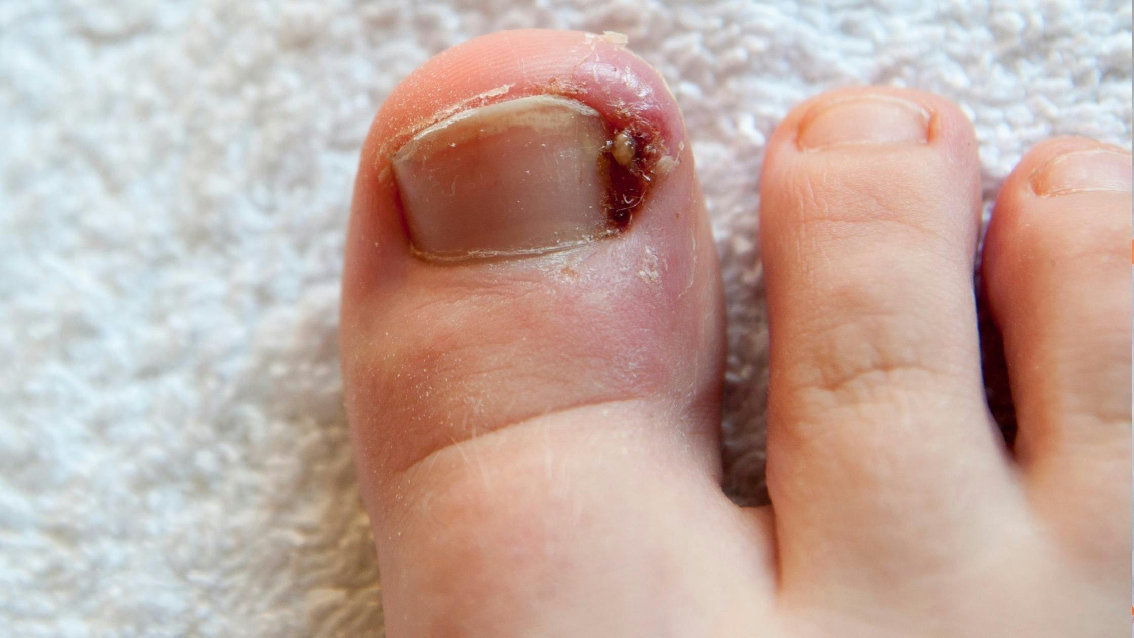 a close up of a person 's foot with a broken toenail .