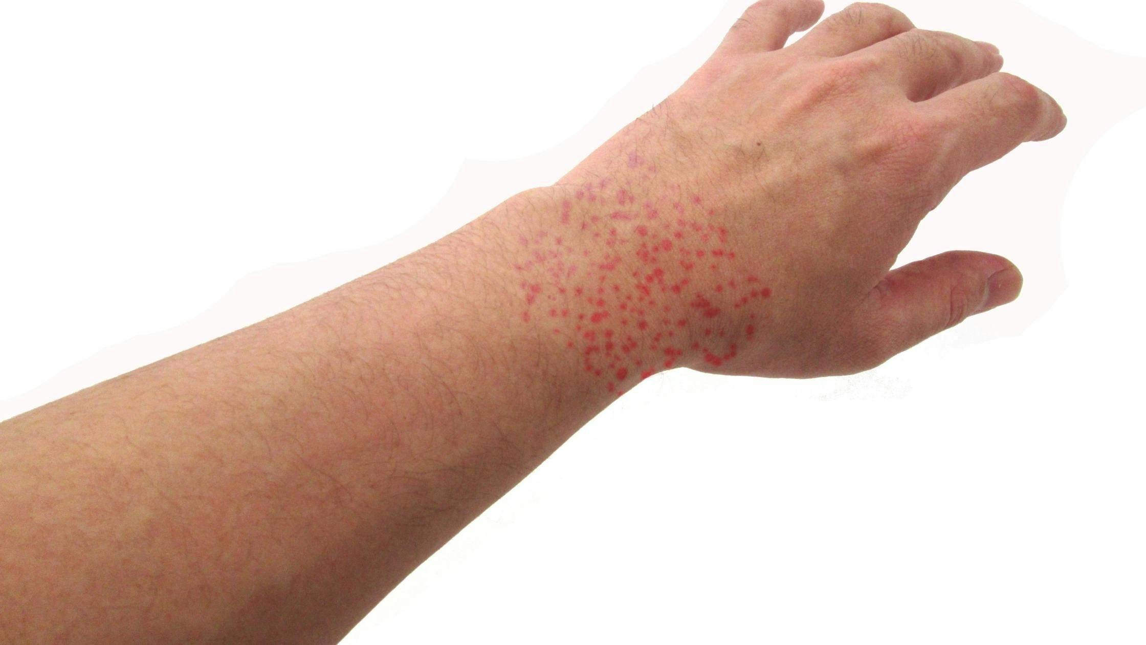 a close up of a person 's arm with red spots on it .