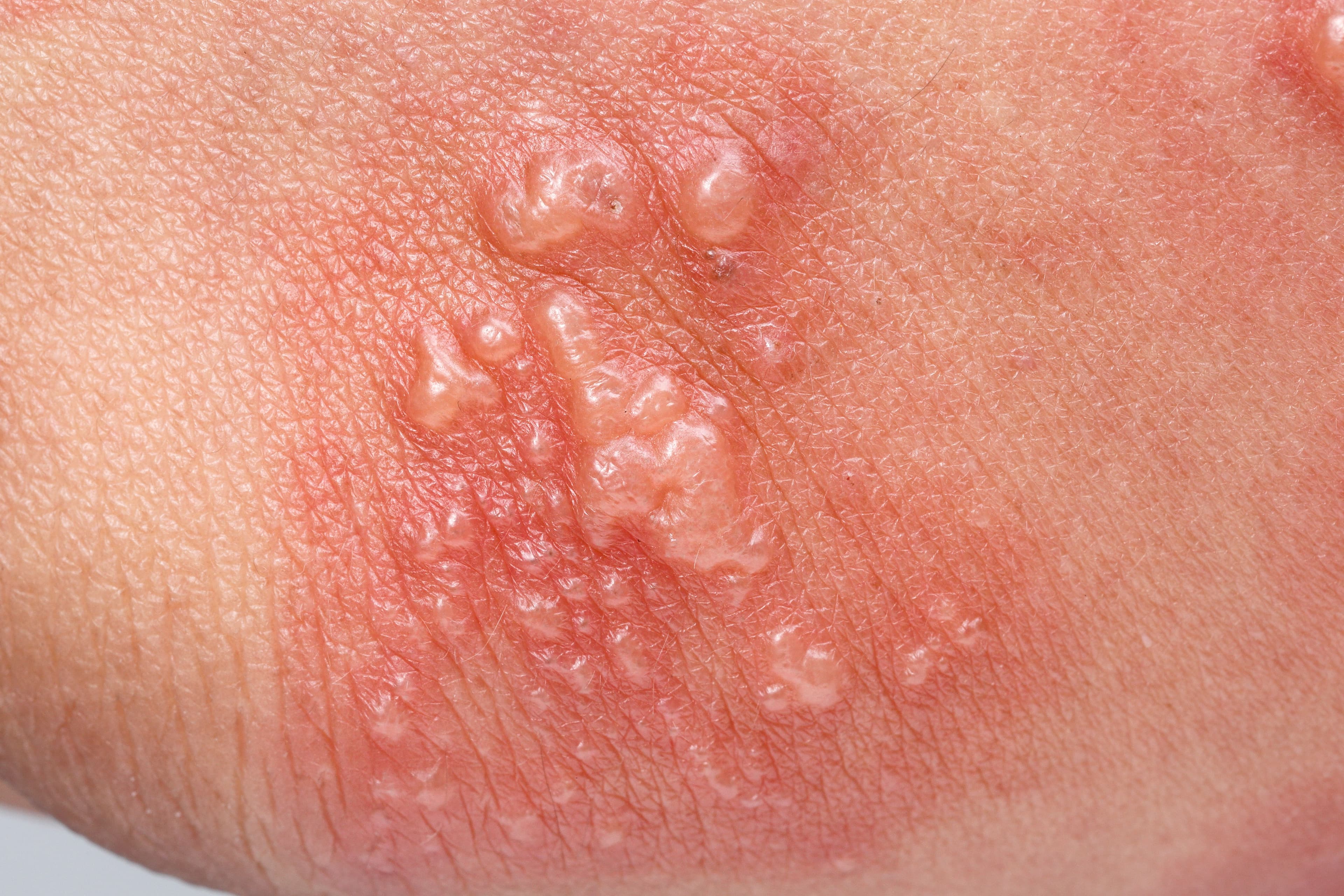 a doctor is talking to a patient about shingles treatment