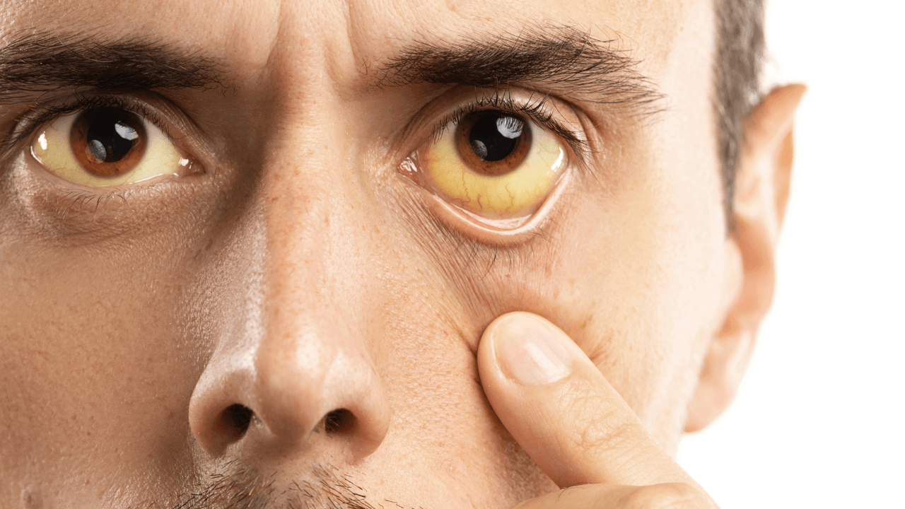 jaundice: a close up of a man 's face with yellow eyes
