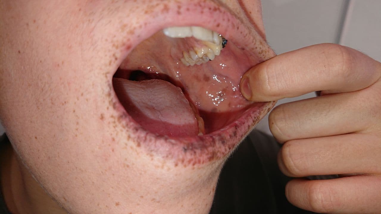 Juvenile Polyposis Syndrome